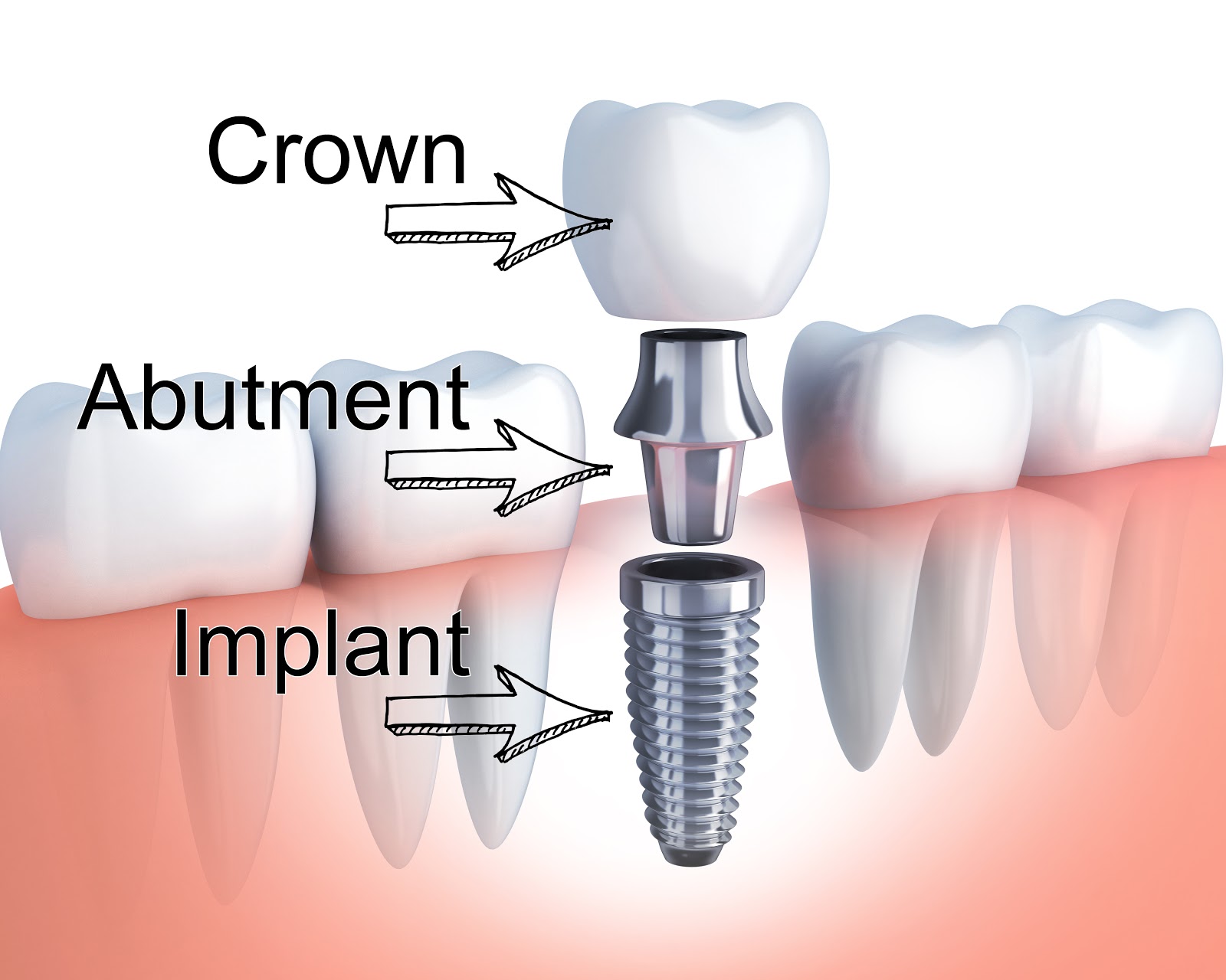 Dental Implants