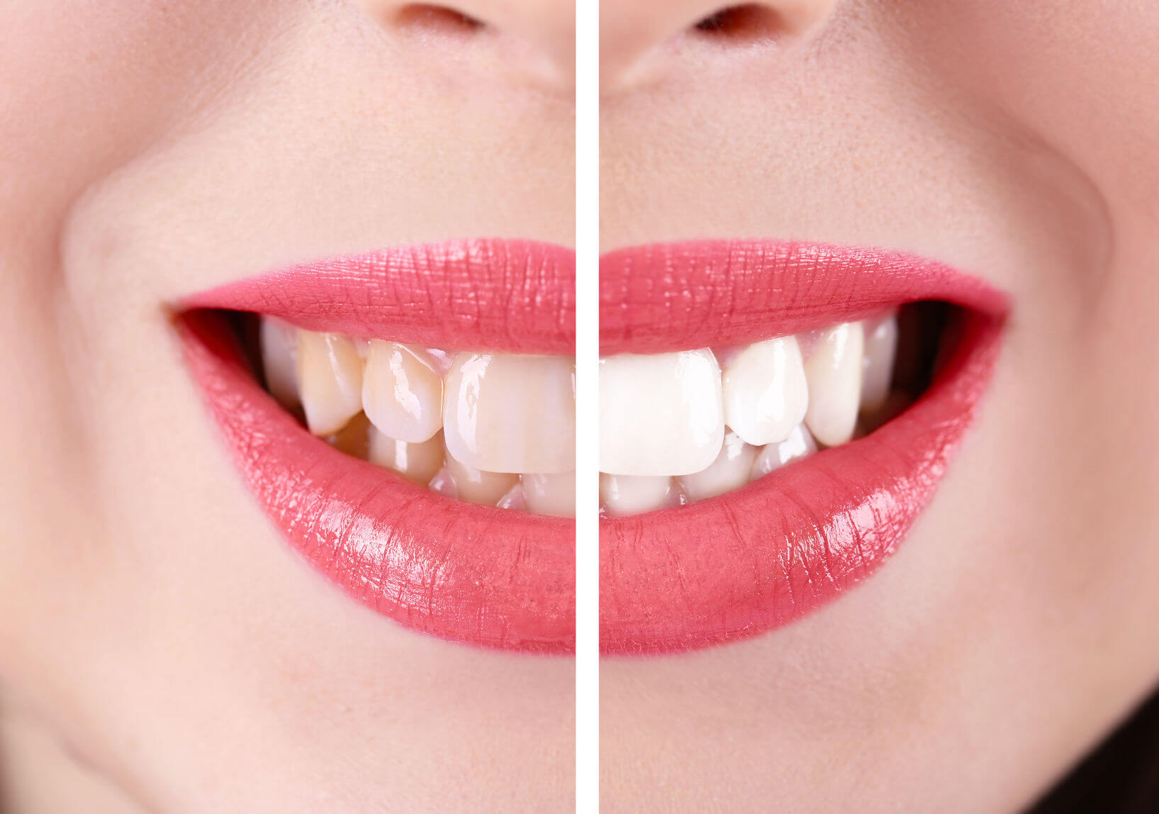 Teeth Whitening