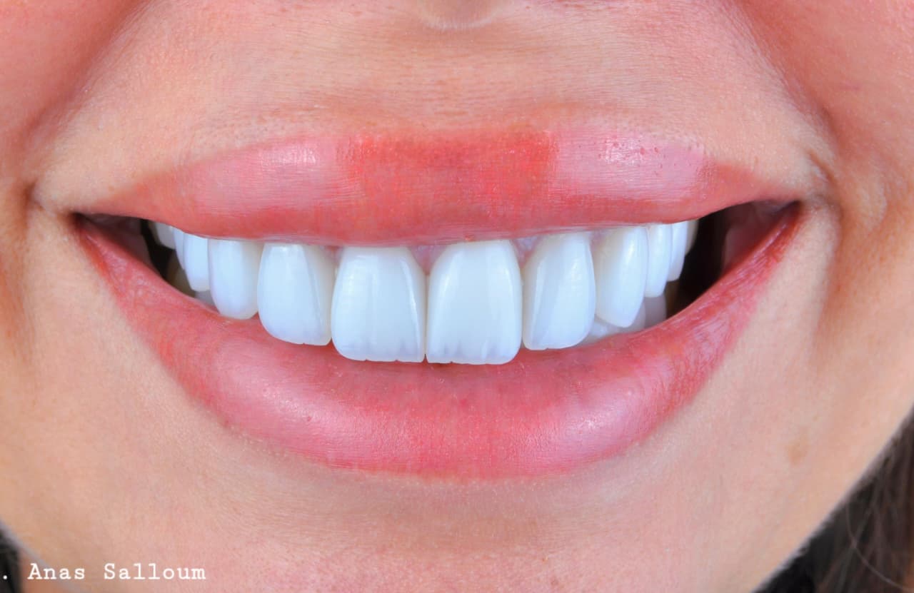 Smile Makeover