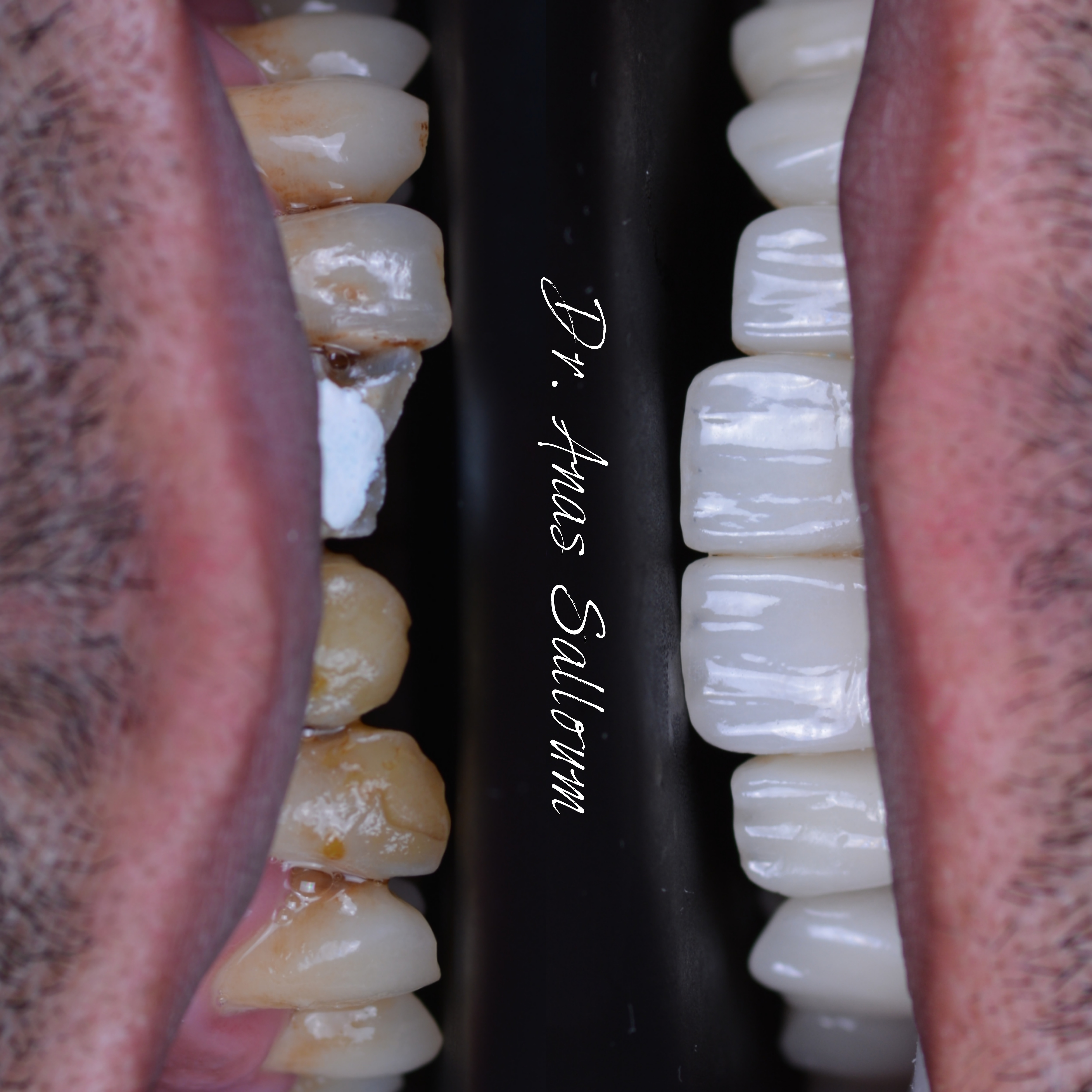 Dental Tools